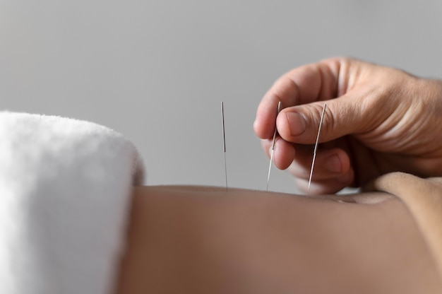 Qué significa soñar con acupuntura