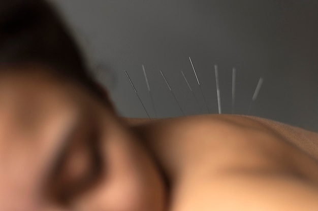 Significado de soñar con acupuntura